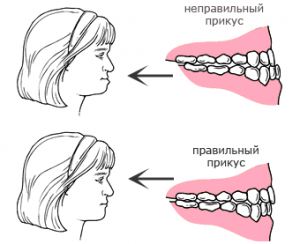 Воспаление сустава челюсти